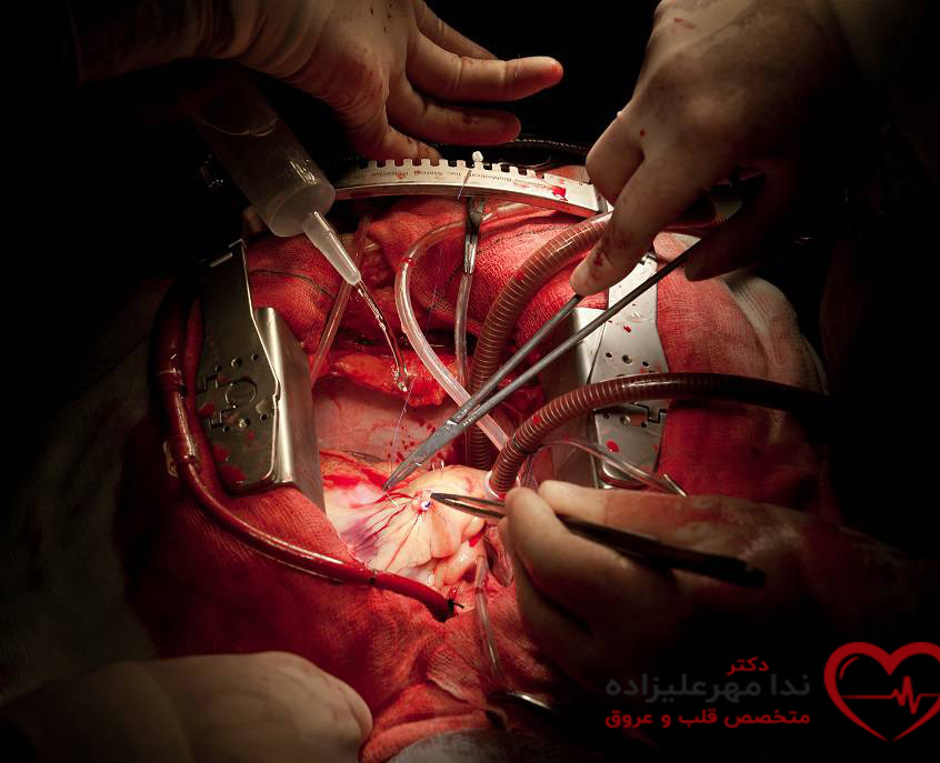در طول عمل جراحی قلب باز